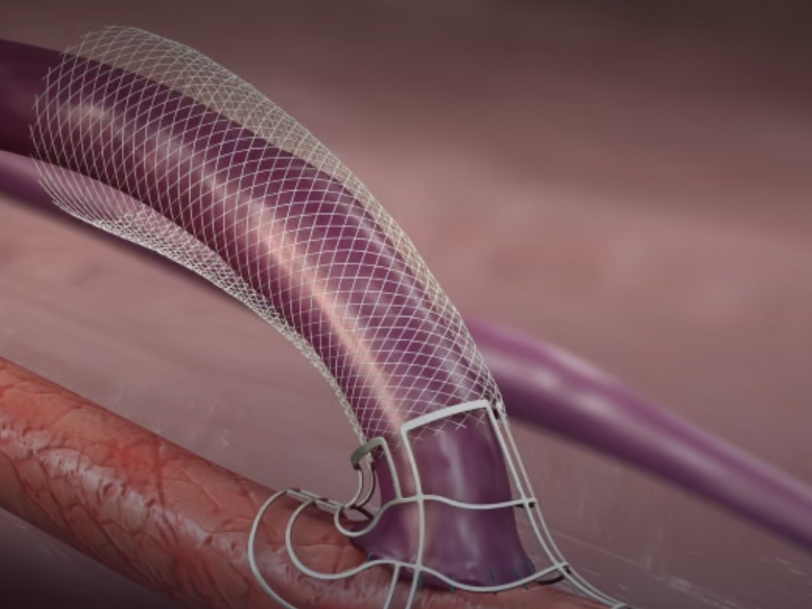 Dispositivo de soporte externo VasQ sobre una fístula arteriovenosa