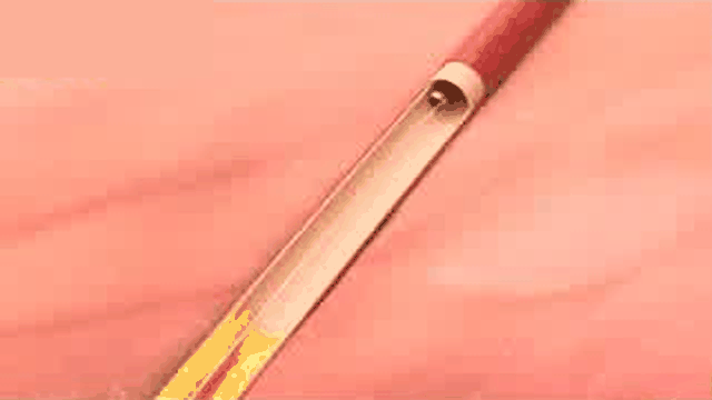 Animación del sistema de aterectomía láser Auryon tratando una placa arterial